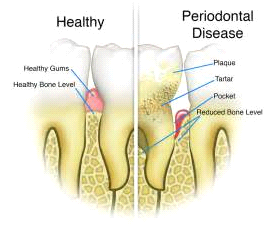 scrape tooth